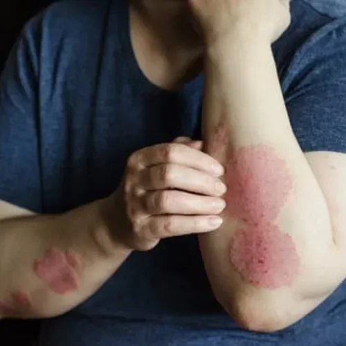 Ayurveda skin care, Natural remedies for itchy skin all over, ayurvedic oils for skin